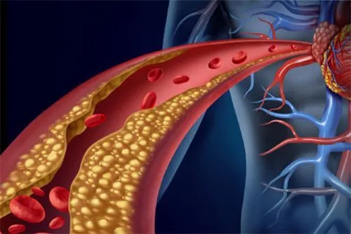 El colesterol insidioso que puede estar amenazando la salud de tu corazónwebp