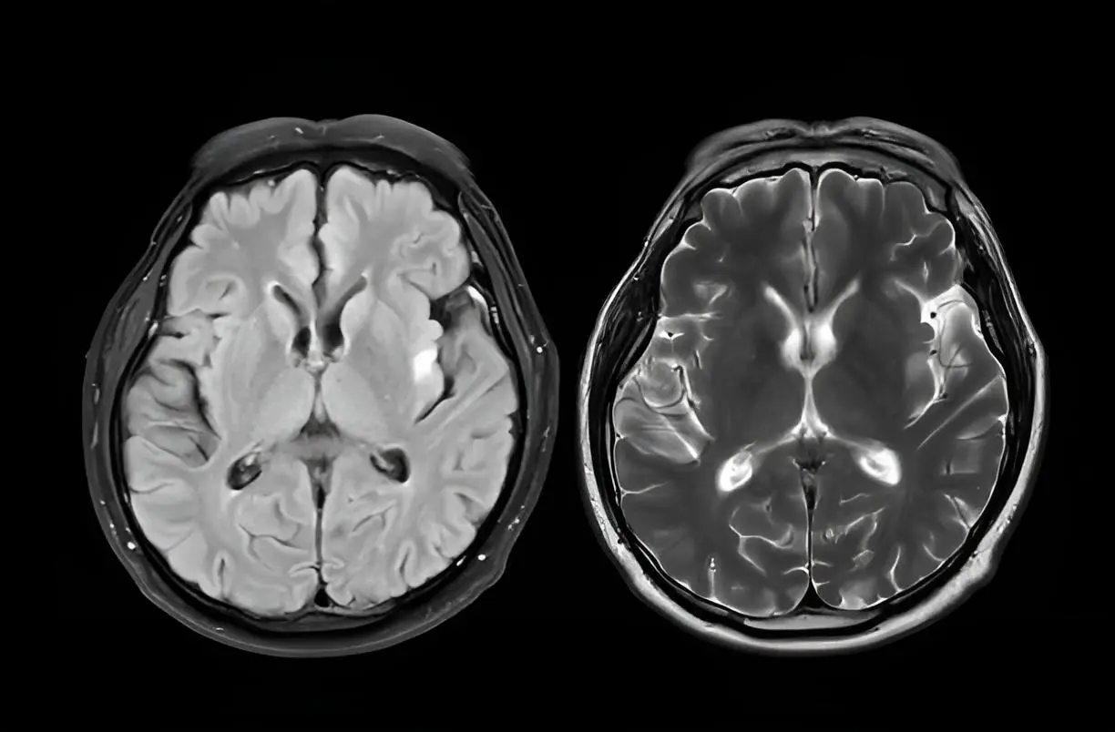 cerebro alzaimer