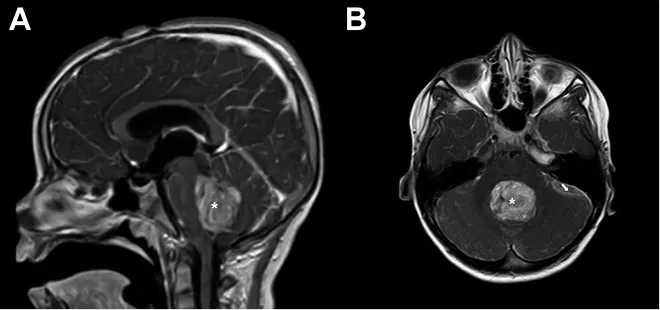 Pérdida bilateral de visión indolora por probable metástasis leptomeníngea durante la respuesta sistémica en adenocarcinoma de esófago