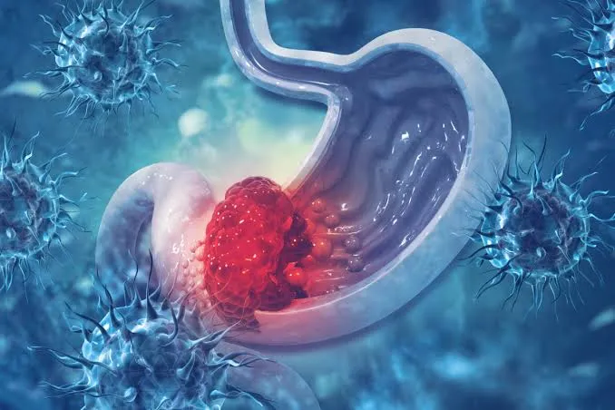 El tratamiento perioperatorio con durvalumab más FLOT demuestra un beneficio significativo en la supervivencia en el adenocarcinoma gástrico