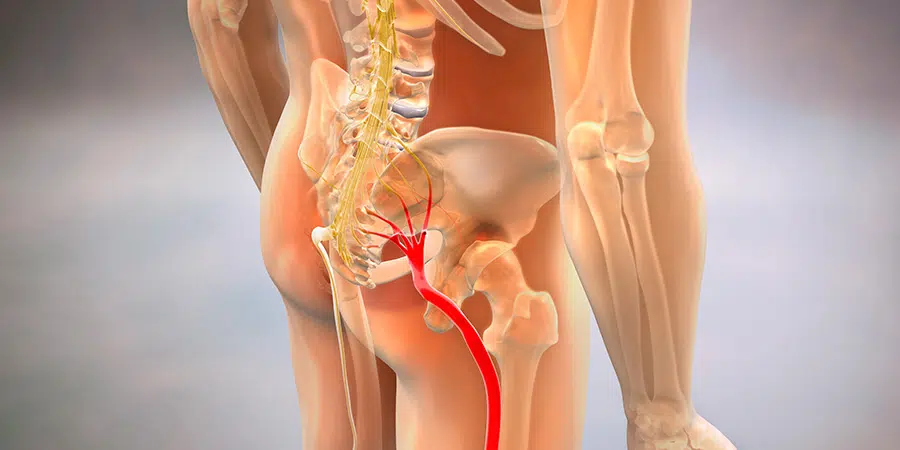 Dolor de ciática qué es por qué aparece y cómo tratarlo de forma segura