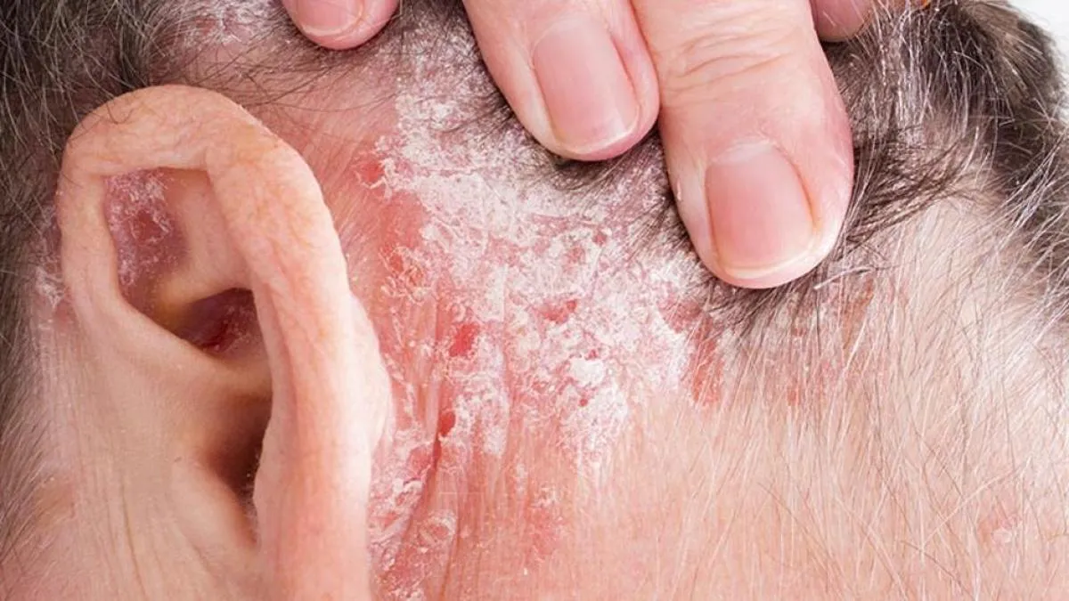 Psoriasis qué es síntomas causas tratamientos y cuidados para controlar los brotes