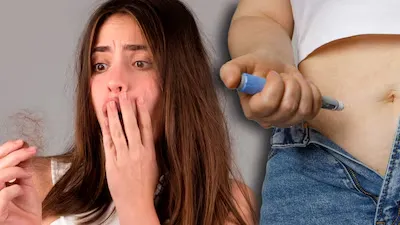 El uso de GLP 1 provoca una pérdida de cabello significativa