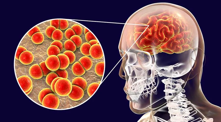 Qué tener en cuenta con la meningitis y las consecuencias de la enfermedad